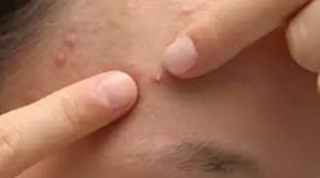 Whitehead Acne